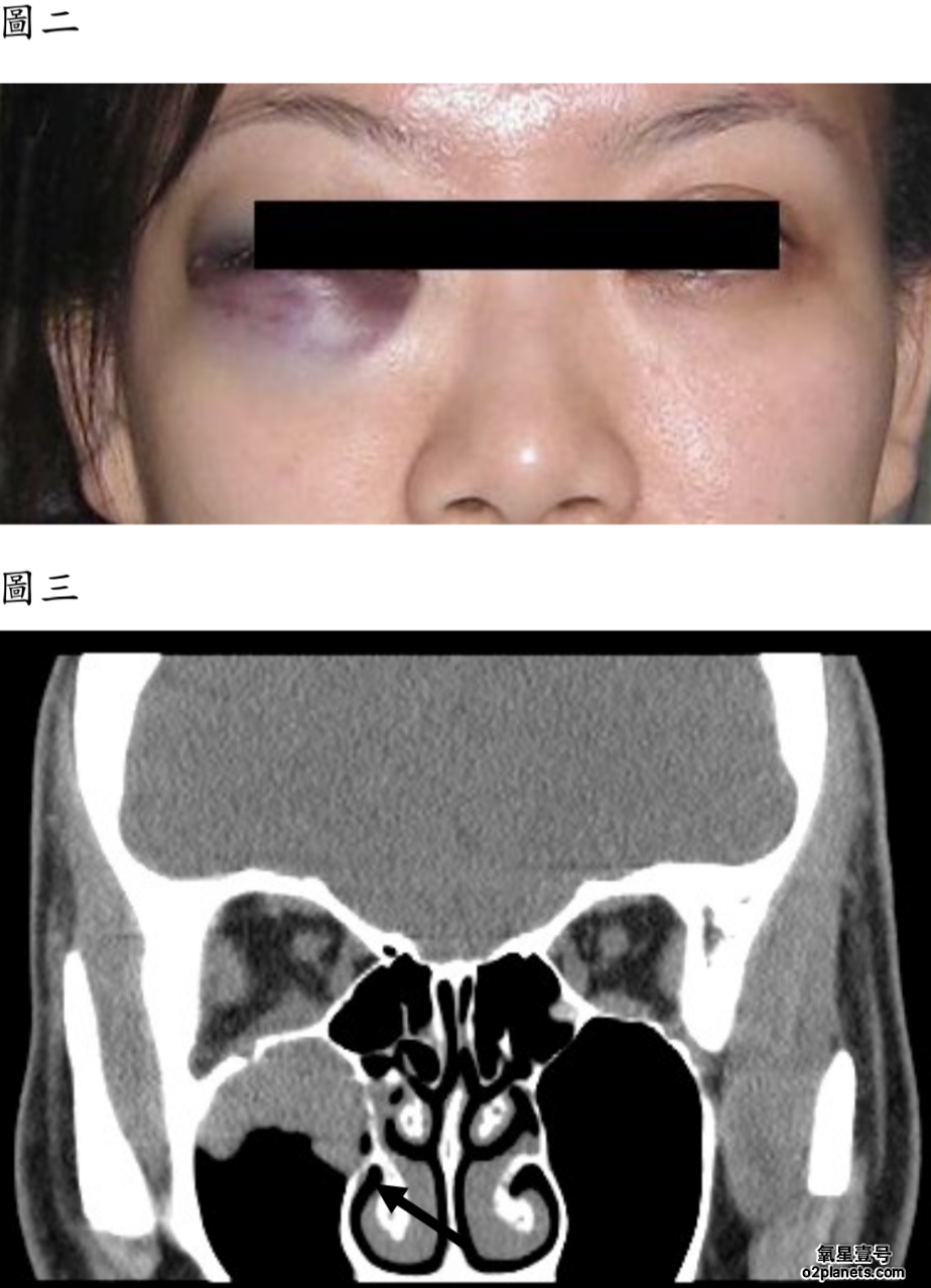 高压氧治疗罕见并发症案例