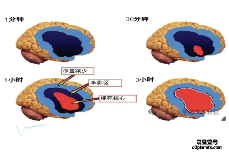 高压氧治疗脑梗塞